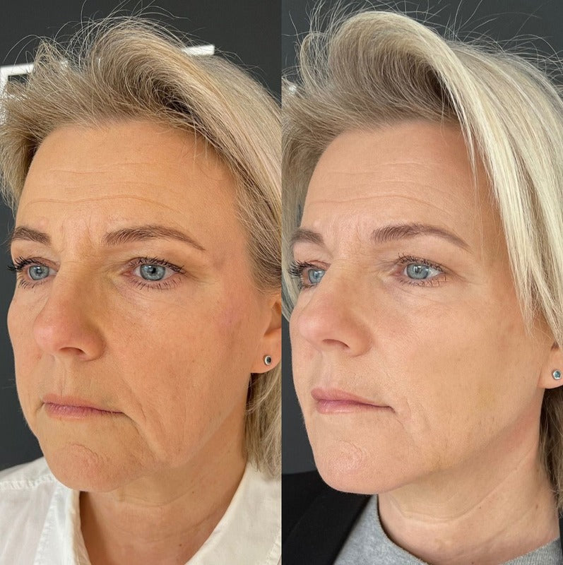 Avant/après Coffret cheveux secs FINOVA