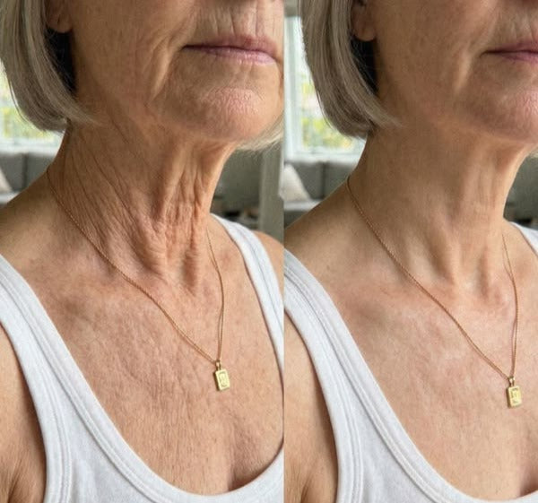 Avant/après Crème cou & décolleté FINOVA